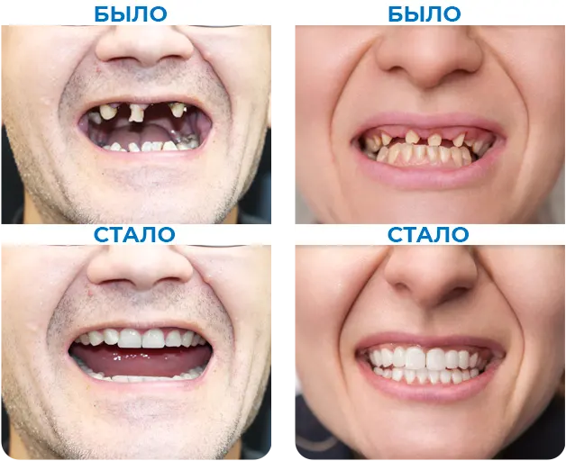 протезирование зубов до и после